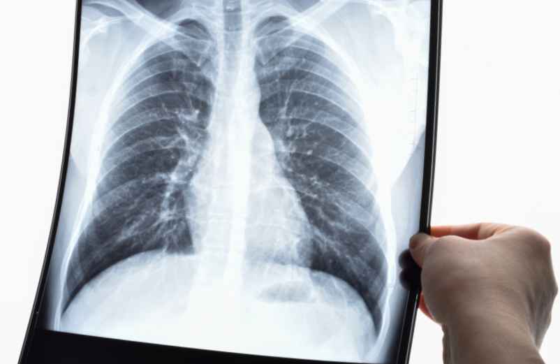 Quel est le traitement pour soigner l’embolie pulmonaire ?